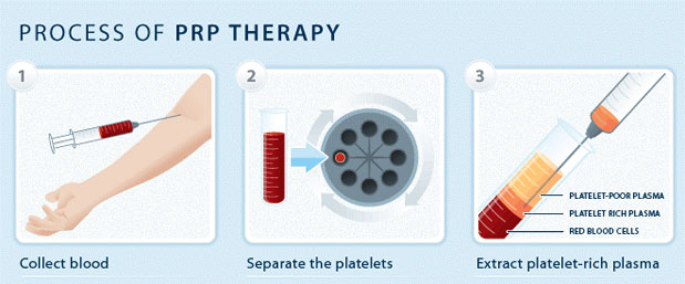 Process of PRP Therapy: 1. Collect Blood 2. Separate the platelets 3. Extract platelet-rich plasma